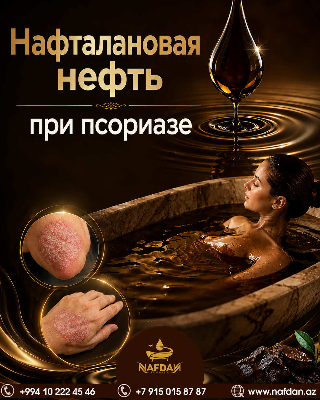 Нафталановая нефть при псориазе